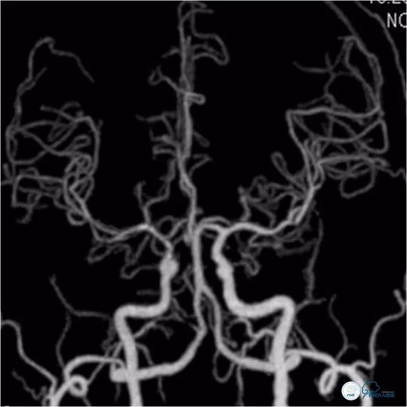 天坛脑血管动脉瘤介入手术,天坛医院脑动脉狭窄