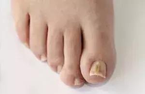 出现脚趾甲凹陷怎么办,脚趾甲发生病变是怎么回事