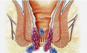 治疗痔疮的药物有哪些比较好用,痔疮快速消肿止痛办法口服药物