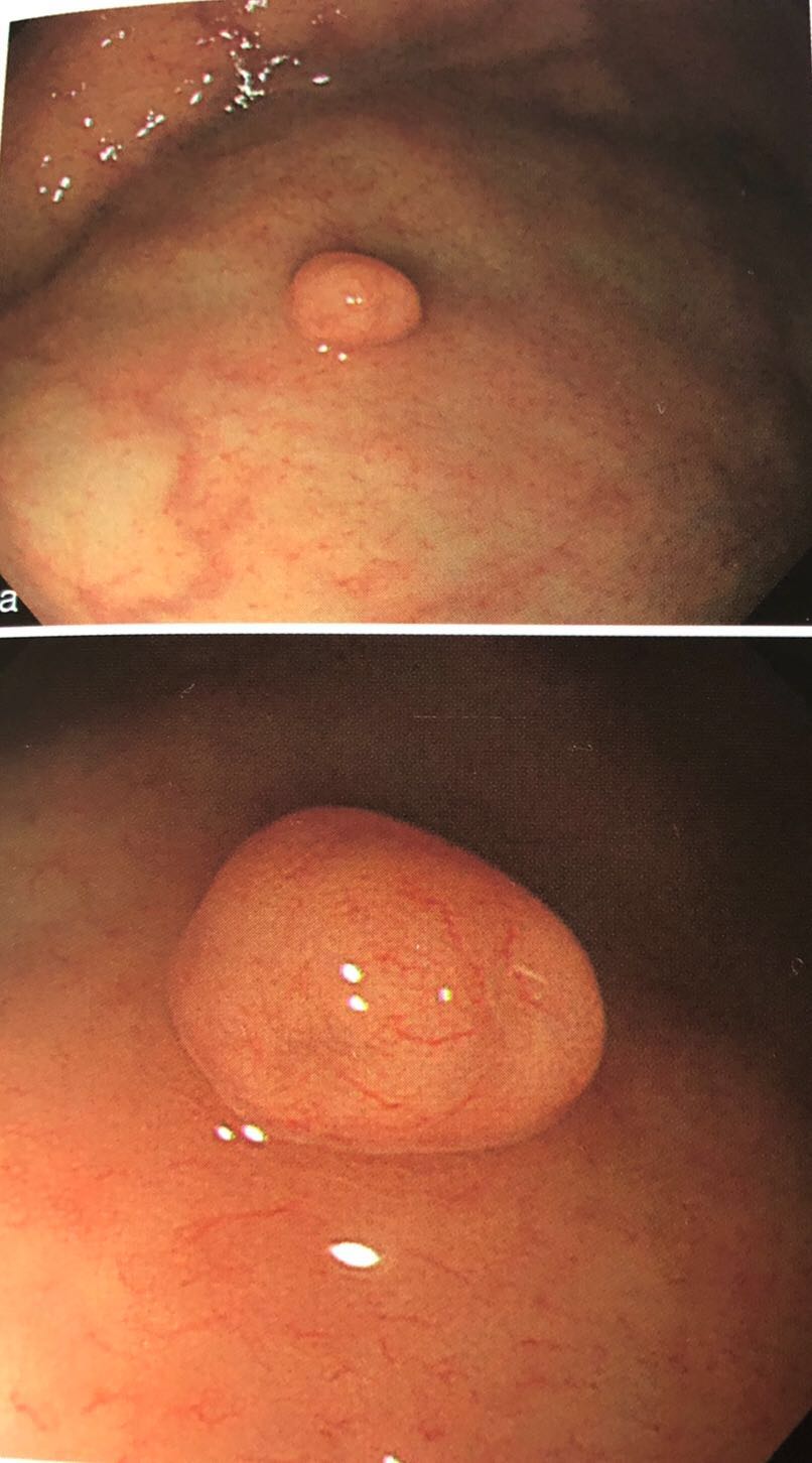 胃镜检查中发现息肉怎么处理,胃镜医生说发现胃肠息肉怎么办