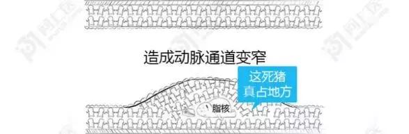 血管硬化可以逆转吗,血管粥样硬化能逆转吗