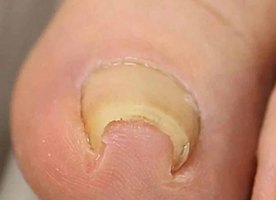 指甲剪太钝了怎么办,指甲剪太进去很痛怎么办