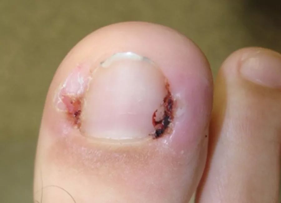 指甲剪太钝了怎么办,指甲剪太进去很痛怎么办