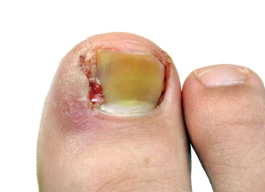 指甲剪太钝了怎么办,指甲剪太进去很痛怎么办