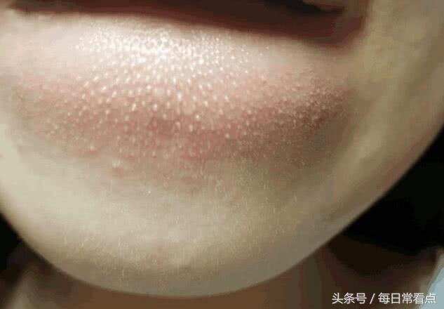 嘴抿起来有小疙瘩,如何去除嘴下的小疙瘩