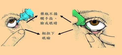滴眼液用错了怎么办,原来滴眼液是这么用的
