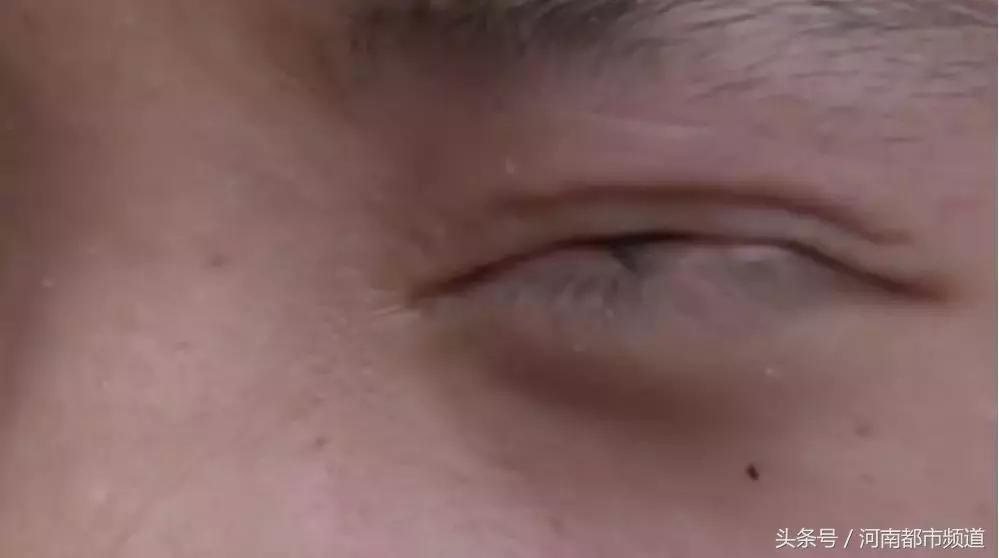 吓人!18岁少女睫毛全扎进眼睛里!父亲为此下跪!太后悔了!