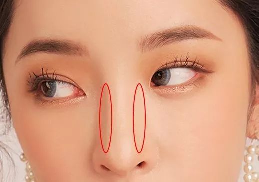 鼻梁塌的自然整鼻,想要高鼻梁三步教你告别塌鼻子