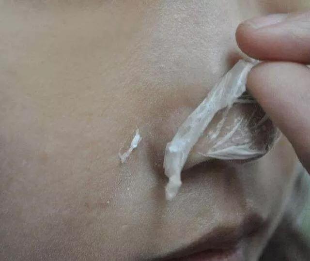 鼻子有个黑点挤出来黄色颗粒,鼻子周围长白色的小米粒