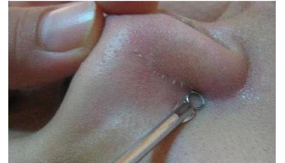 鼻子有个黑点挤出来黄色颗粒,鼻子周围长白色的小米粒