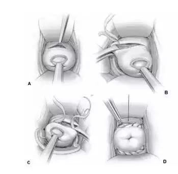 宫颈口松弛容易流产吗,宫颈松弛怀孕第一个月会流产吗
