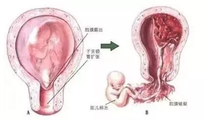宫颈口松弛容易流产吗,宫颈松弛怀孕第一个月会流产吗
