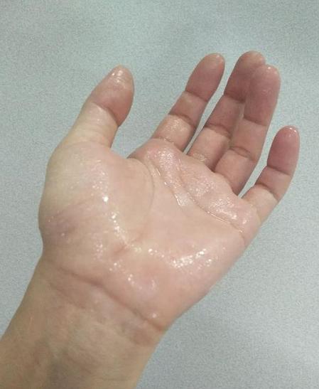 手上老是淌汗需要做手术吗,季节性手起小水泡彻底治疗