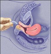 专家介绍阴道炎典型的症状表现,各类阴道炎症状和用药