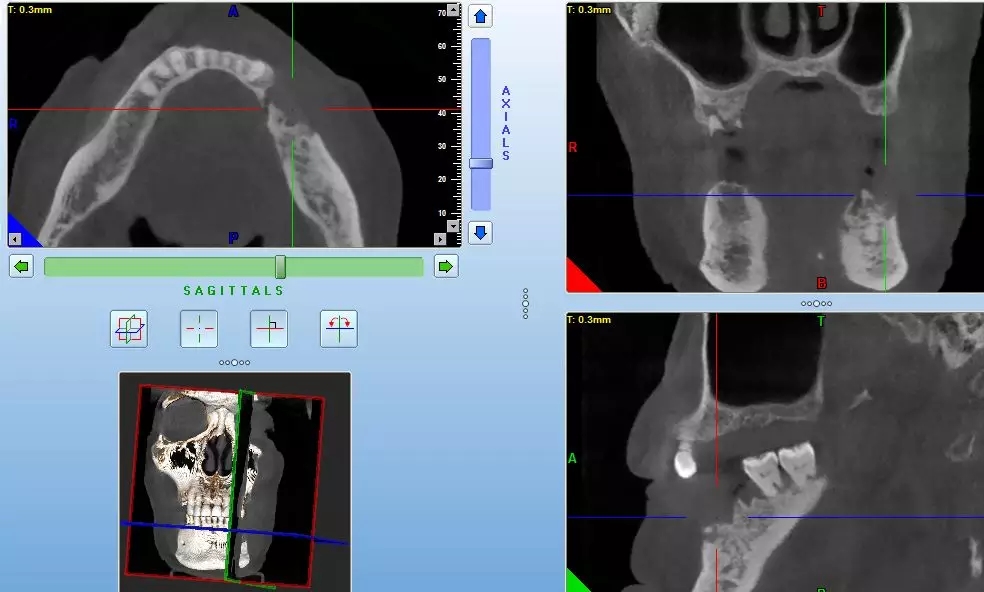 服用双膦酸盐类药物拔牙,双膦酸盐用药期间拔牙的危害