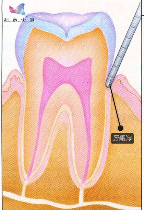 冲牙器改善牙龈出血,超声波冲牙器清洁牙垢是否有效果