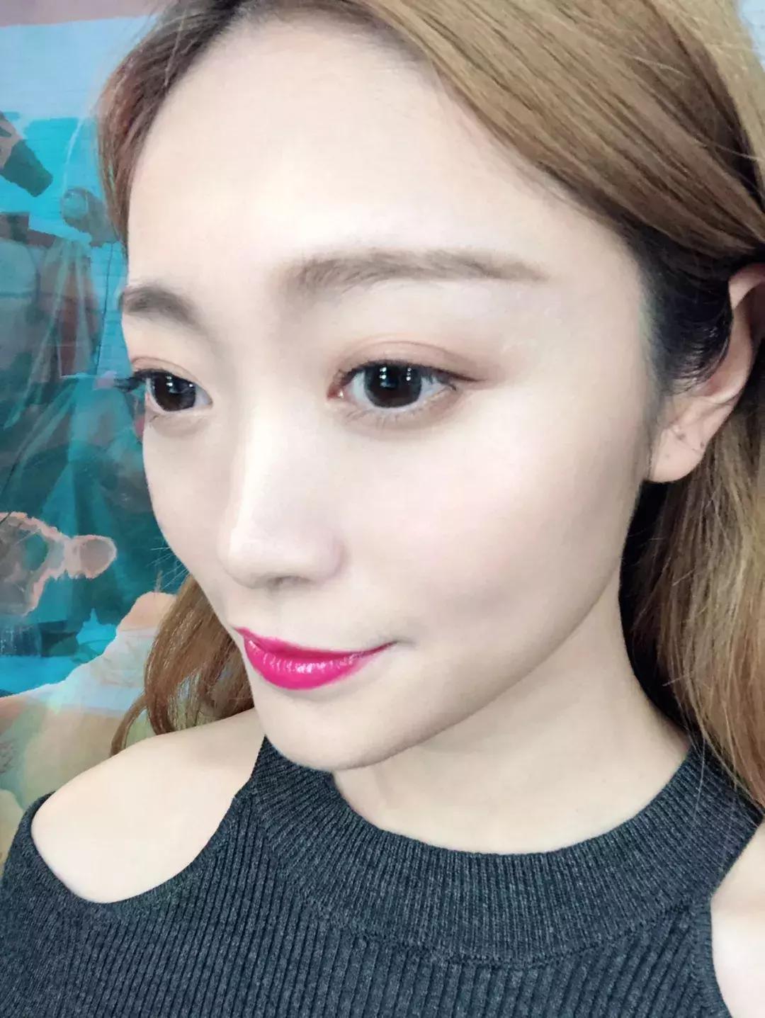 蒜头鼻怎么改变鼻型,蒜头鼻厚鼻翼怎么矫正