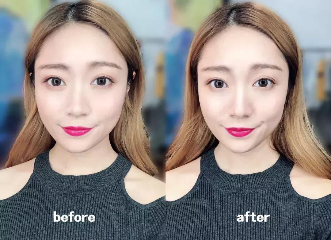 蒜头鼻怎么改变鼻型,蒜头鼻厚鼻翼怎么矫正