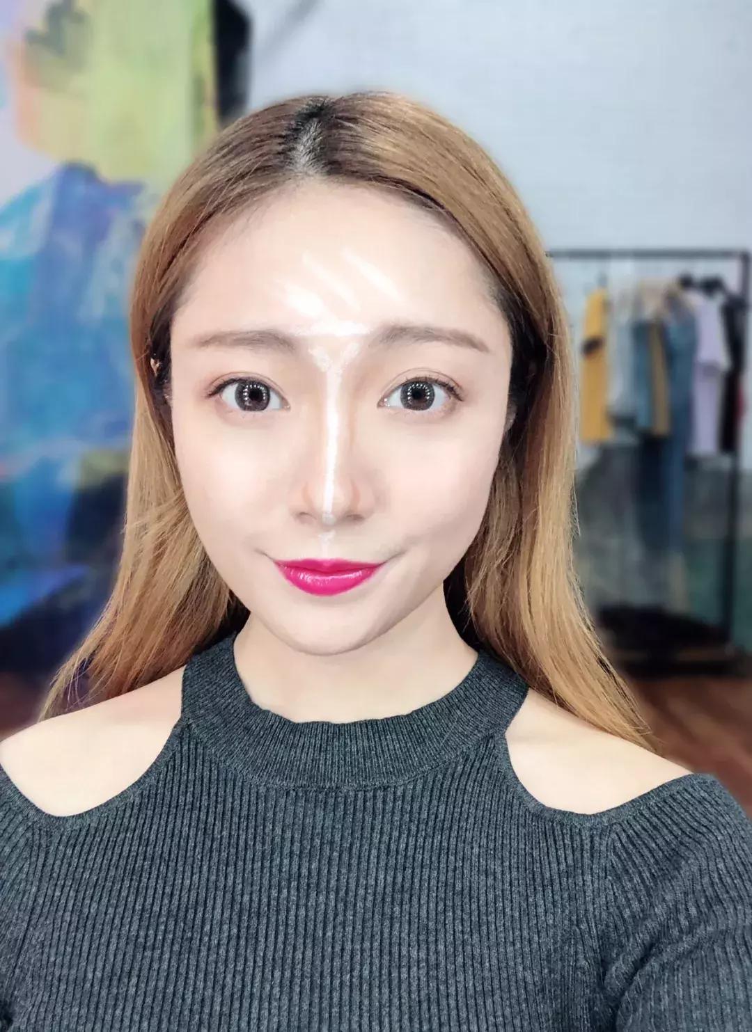 蒜头鼻怎么改变鼻型,蒜头鼻厚鼻翼怎么矫正