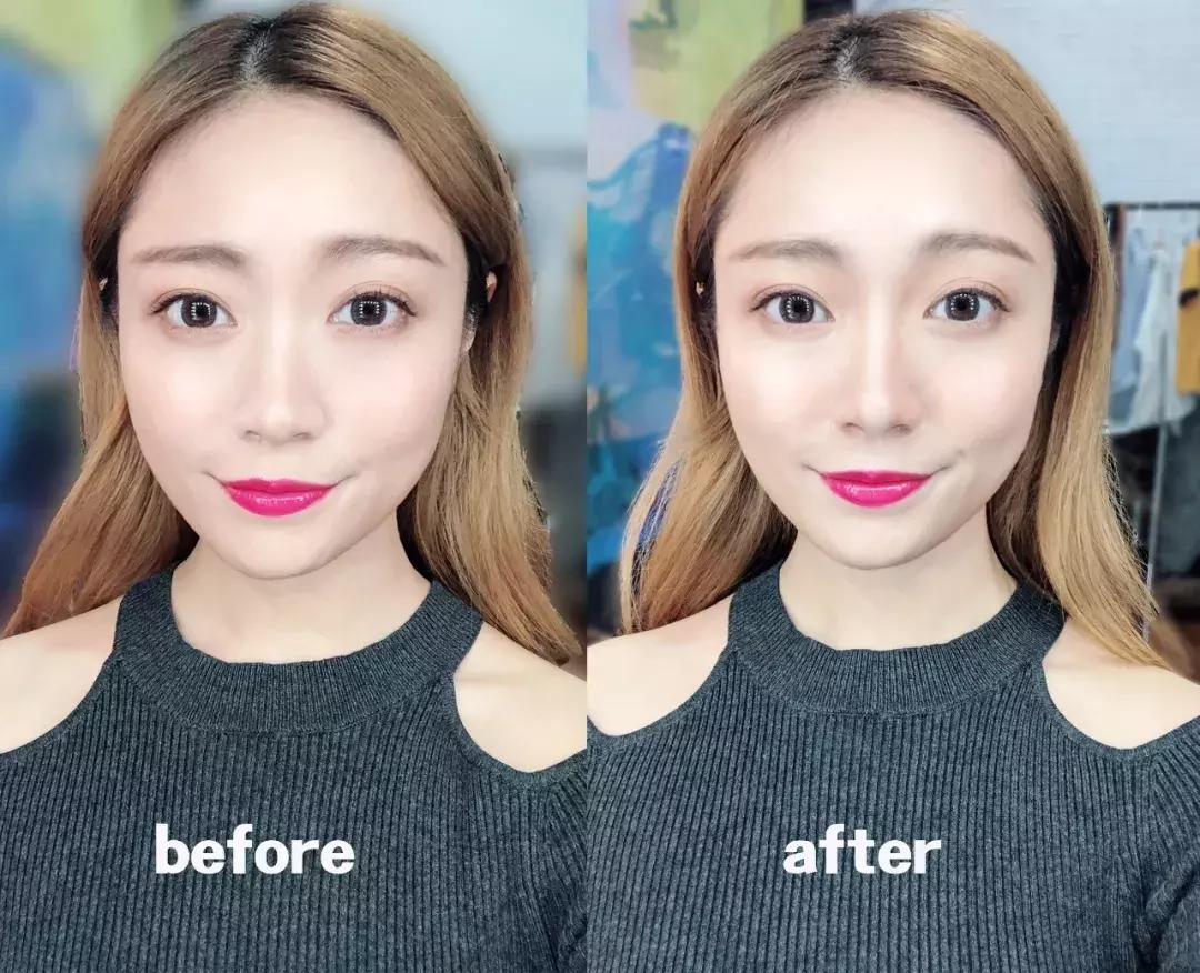 蒜头鼻怎么改变鼻型,蒜头鼻厚鼻翼怎么矫正