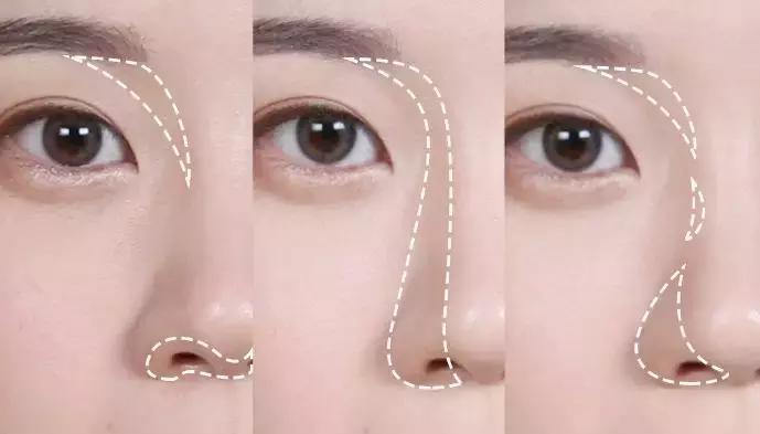 蒜头鼻怎么改变鼻型,蒜头鼻厚鼻翼怎么矫正