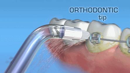 冲牙器改善牙龈出血,超声波冲牙器清洁牙垢是否有效果