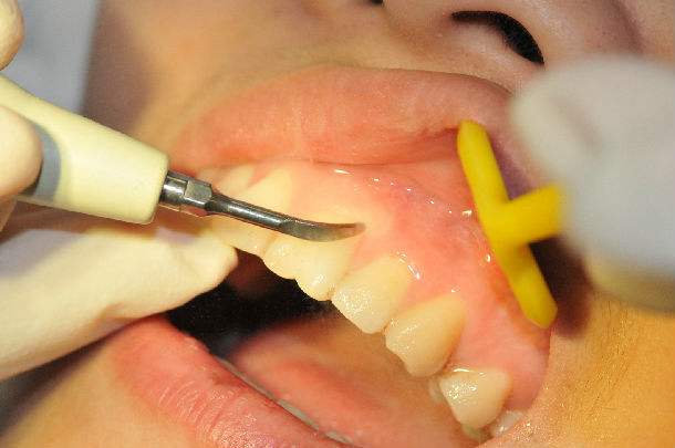 冲牙器改善牙龈出血,超声波冲牙器清洁牙垢是否有效果