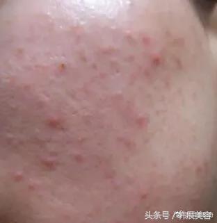 防止脸上长粉刺的方法,脸上长斑要当心