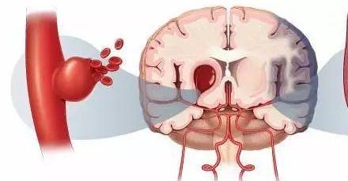 出血性脑血管疾病的临床表现,出血性脑血管病变的症状