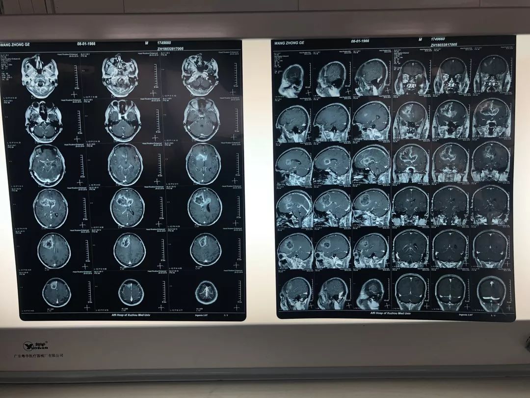 恶性胶质脑瘤低级别,恶性脑胶质瘤浙江大学