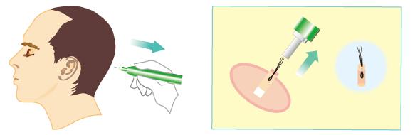 头发是怎么种出来的,种头发能和原来头发一样吗