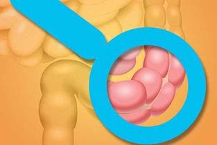 发现息肉后怎样去干预和调整,结肠息肉1.2活检会是癌吗