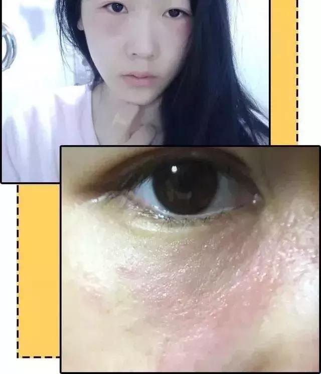可怕!她把痔疮膏当眼霜涂了以后……差点儿毁容了!