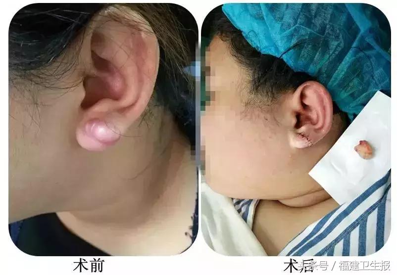 打耳洞后耳朵里长肉球怎么办,打耳洞后女子耳垂长出肉疙瘩