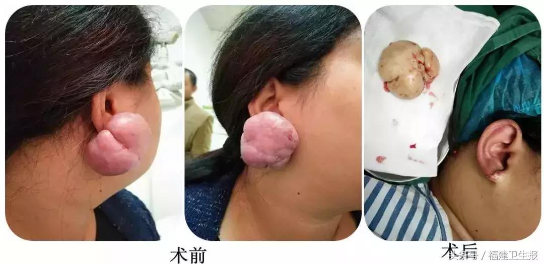 打耳洞后耳朵里长肉球怎么办,打耳洞后女子耳垂长出肉疙瘩