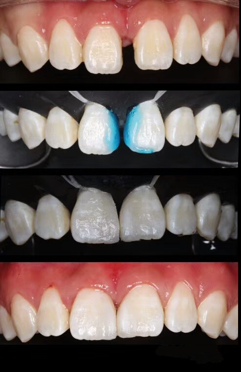 怎么缩小门牙牙缝,门牙牙缝怎么修复最简单方法