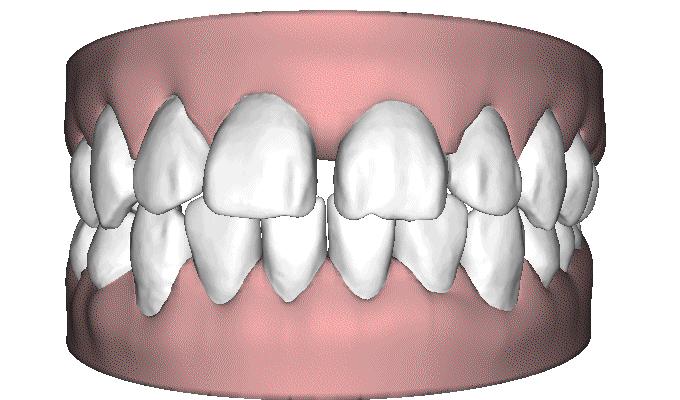 怎么缩小门牙牙缝,门牙牙缝怎么修复最简单方法