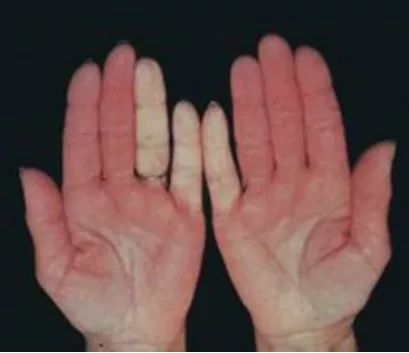 17岁女孩牙齿掉光了是咋回事,45岁女子牙齿都掉光