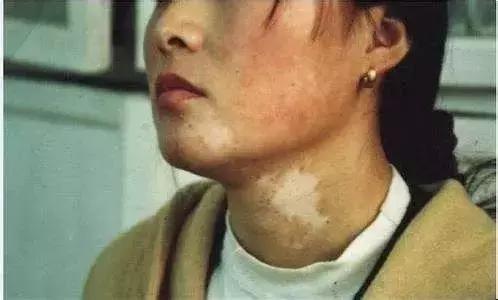 邯郸中药调理白癜风中医诊所,白癜风分型分期治疗的难度