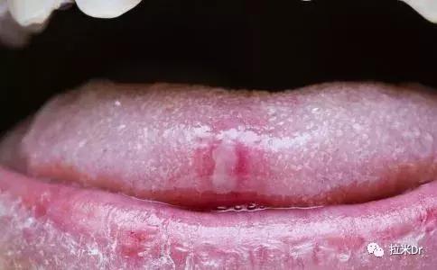 hiv感染者有症状的比例,身上多处真菌感染和hiv有关系吗