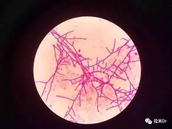 hiv感染者有症状的比例,身上多处真菌感染和hiv有关系吗