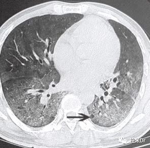 hiv感染者有症状的比例,身上多处真菌感染和hiv有关系吗