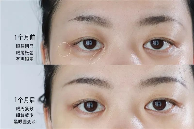 2周!黑眼圈没了、眼纹也淡了这个“眼周小熨斗”让眼睛年轻了10岁不止!