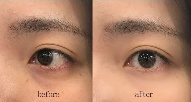 2周!黑眼圈没了、眼纹也淡了这个“眼周小熨斗”让眼睛年轻了10岁不止!