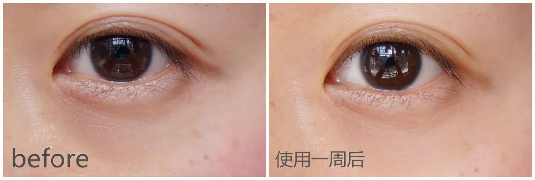 2周!黑眼圈没了、眼纹也淡了这个“眼周小熨斗”让眼睛年轻了10岁不止!