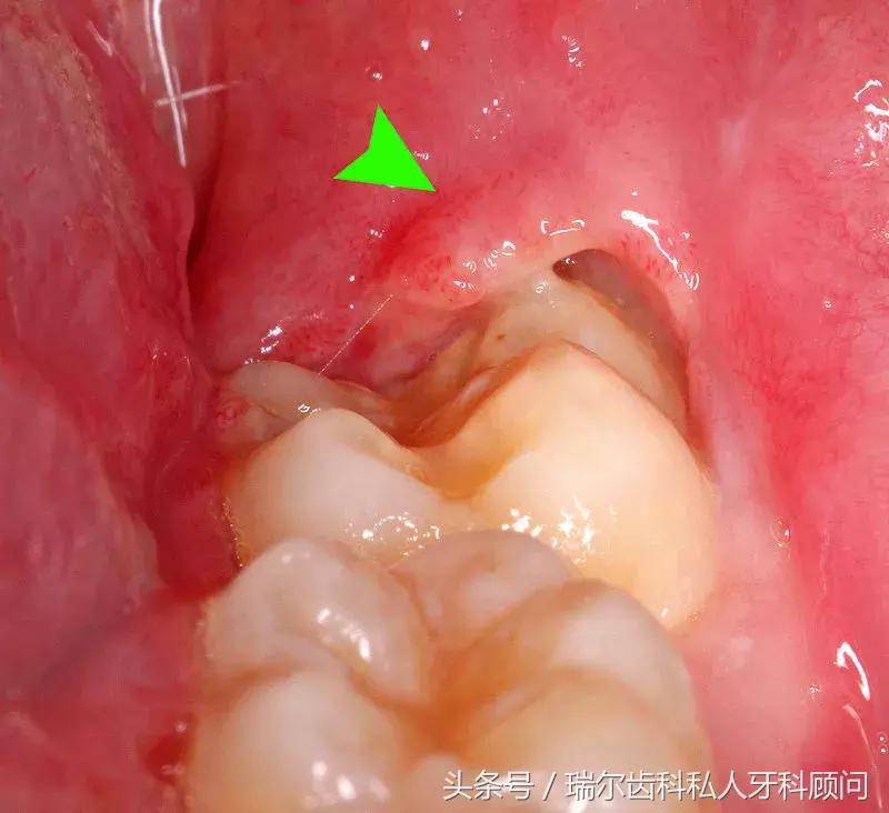 又肿又痛不会白怎么处理,又肿又痛可以去拔牙吗