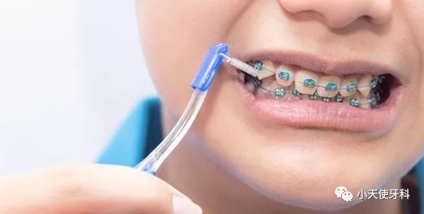 牙齿上的黑三角是怎么形成的,牙齿上的黑三角怎么治疗