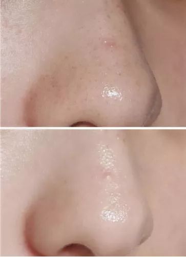 比激光祛疤还厉害的祛疤技术,一秒祛痘磨皮神器