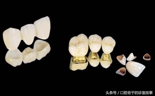 烤瓷冠什么样的最好,烤瓷冠大概多少钱一颗