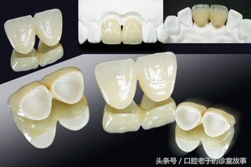 烤瓷冠什么样的最好,烤瓷冠大概多少钱一颗